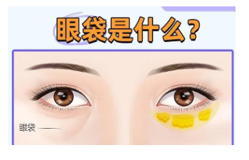 去眼袋手术