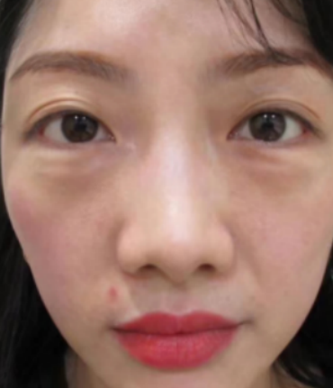 眼袋