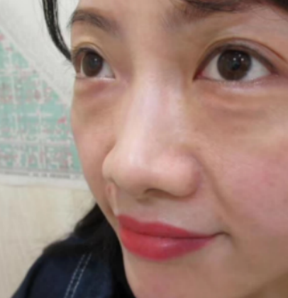 眼袋
