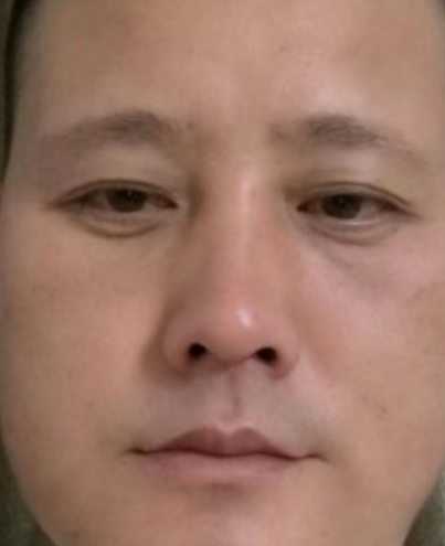 眼袋