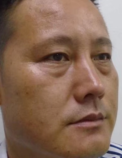 眼袋