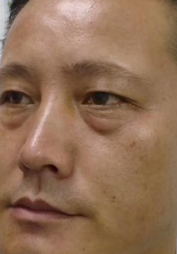 眼袋