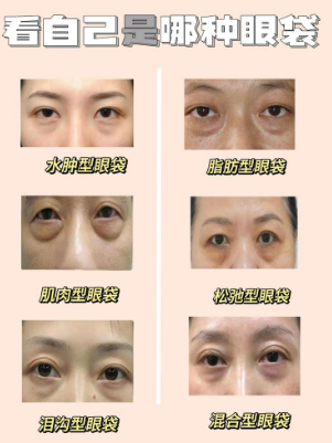 眼袋