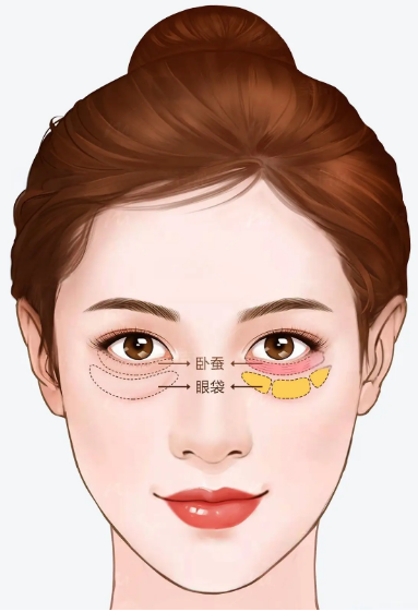 眼袋