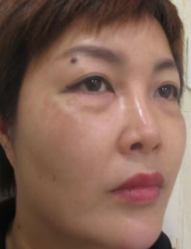 去眼袋手术