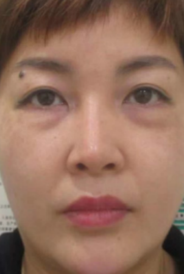 去眼袋手术