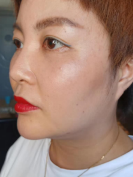 去眼袋手术