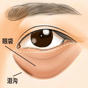 去眼袋手术