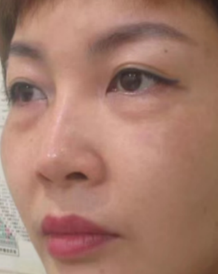 去眼袋手术
