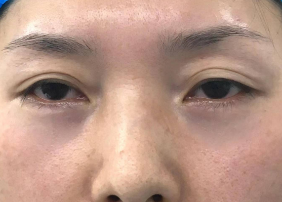 眼袋
