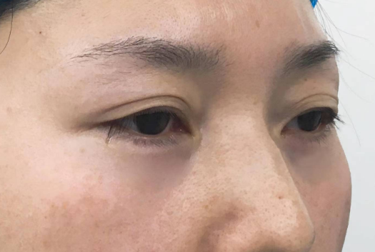 眼袋