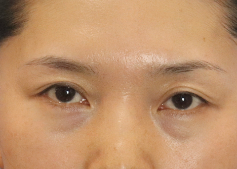 眼袋