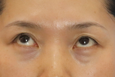 眼袋