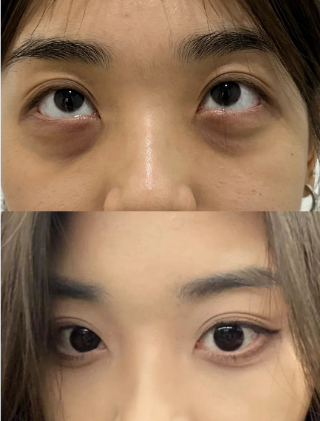 去眼袋手术
