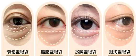 眼袋