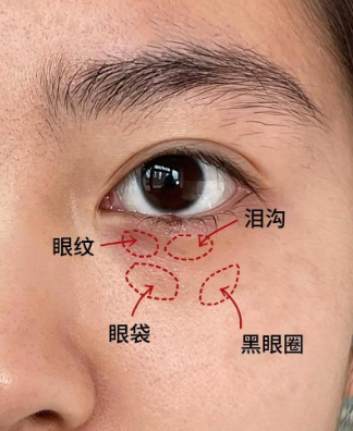眼袋