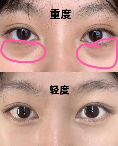眼袋