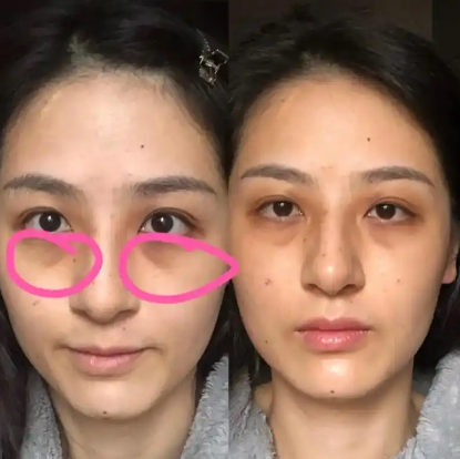 眼袋