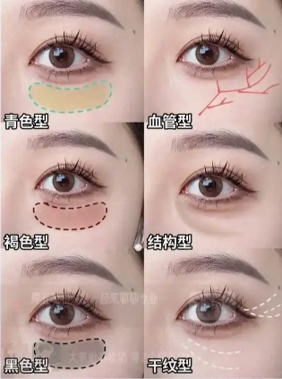 眼袋
