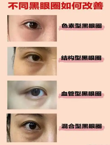 眼袋