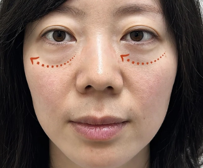 眼袋