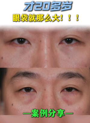 眼袋