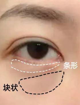 眼袋
