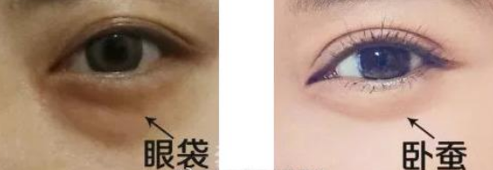 眼袋