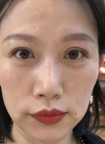 去眼袋手术