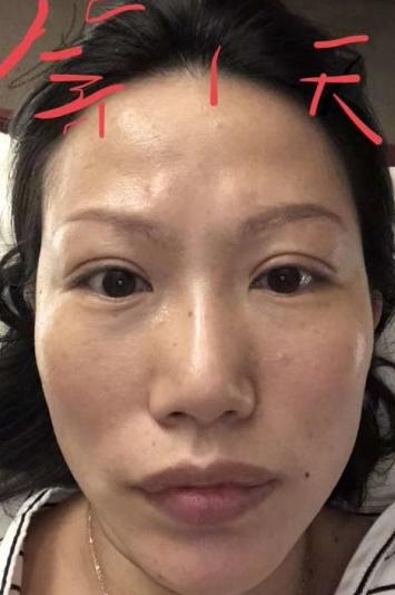 去眼袋手术