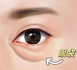 去眼袋手术
