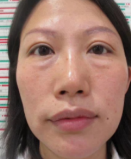 去眼袋手术