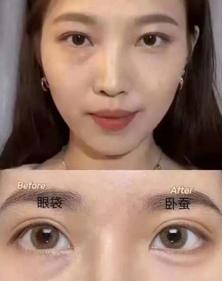 去眼袋手术