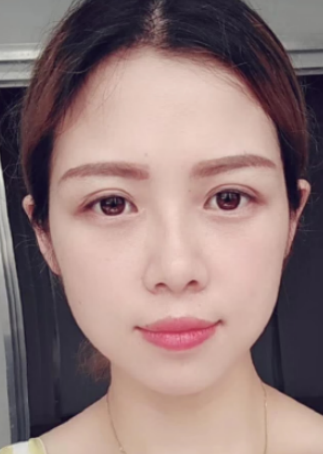 去眼袋手术