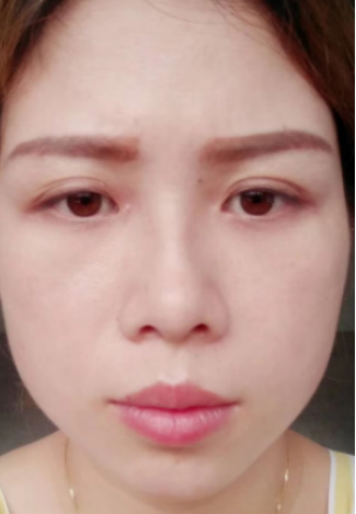 去眼袋手术