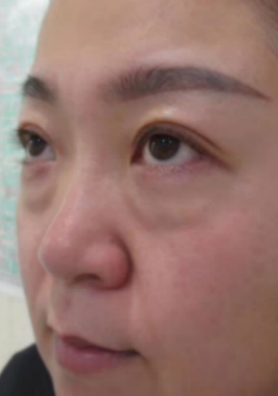 去眼袋手术