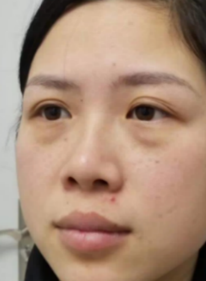 去眼袋手术