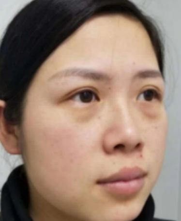 去眼袋手术