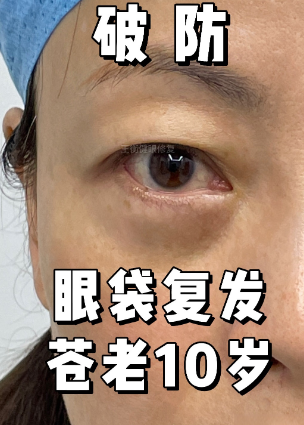 去眼袋手术