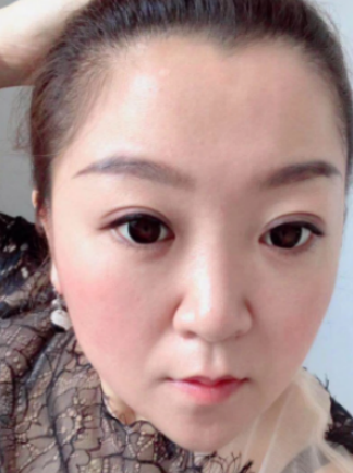 去眼袋手术