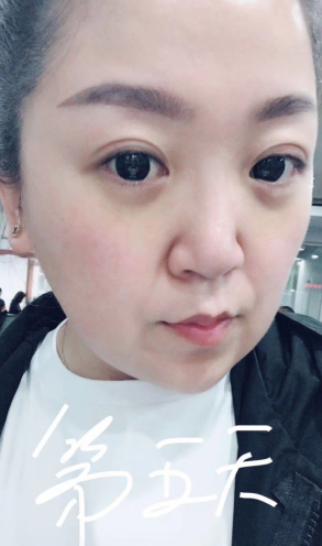 去眼袋手术