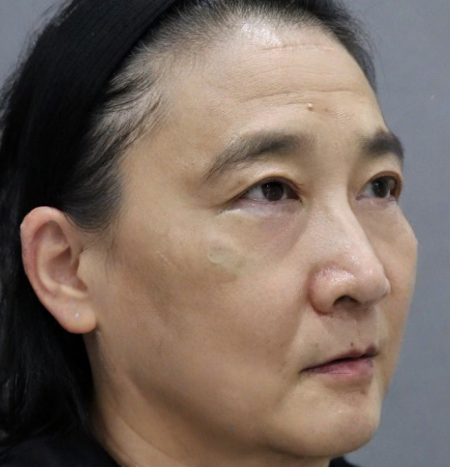 去眼袋手术
