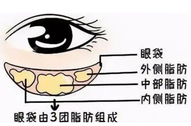 去眼袋手术