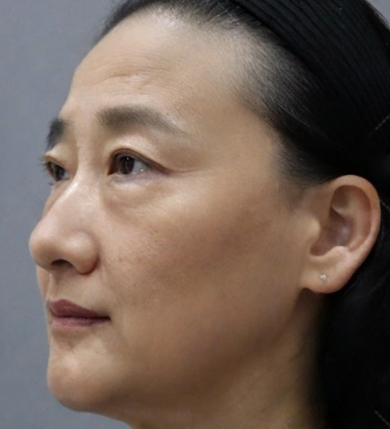 去眼袋手术