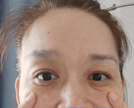 去眼袋手术