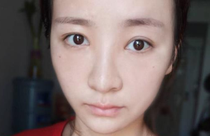 去眼袋手术