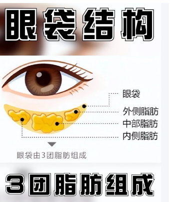 去眼袋手术