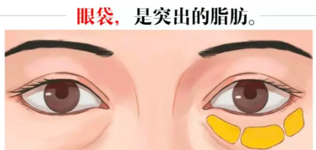 去眼袋手术
