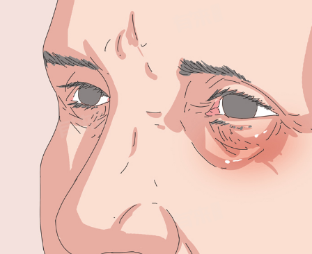 眼袋