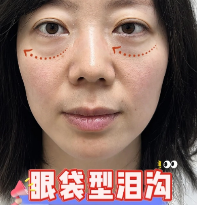 眼袋